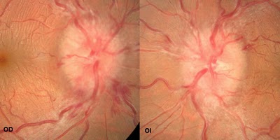 Papiledema